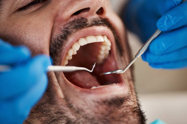 Best Emergency Dental Care for Abscessed Tooth in Beechwood, MS